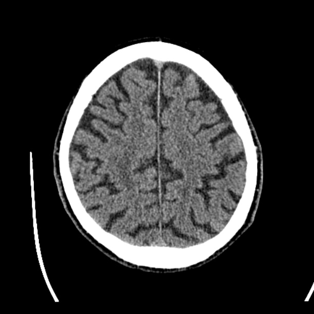 Cerebellar hemorrhage (Radiopaedia 27193-27359 Axial non-contrast 41).jpg