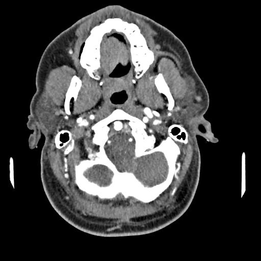 Cerebellar infarct due to vertebral artery dissection with posterior fossa decompression (Radiopaedia 82779-97029 C 49).png