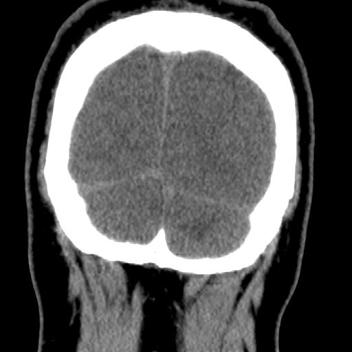 Cerebellar infarction (Radiopaedia 16625-16327 Coronal non-contrast 41).jpg
