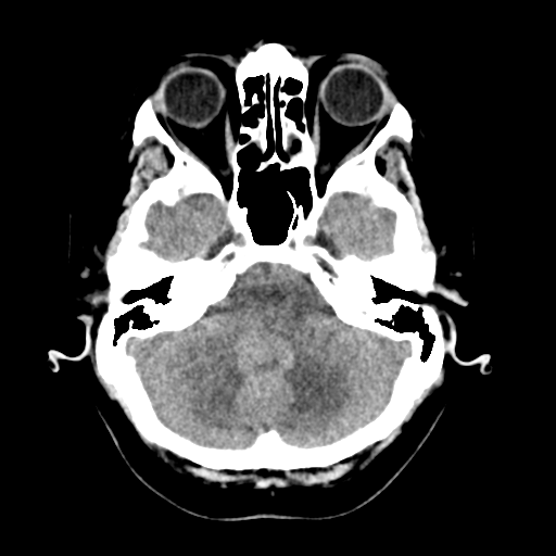 Cerebellar metastasis (Radiopaedia 54578-60812 Axial non-contrast 11).png