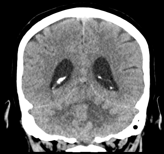 File:Cerebellar metastasis (Radiopaedia 54578-60812 Coronal non-contrast 40).png