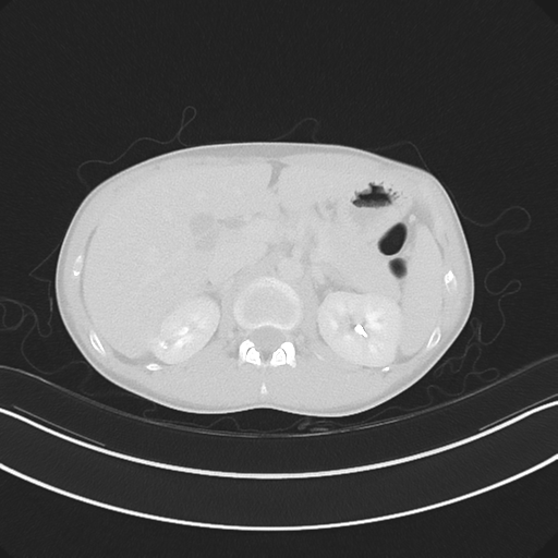Cerebellar metastasis - adenocarcinoma lung (Radiopaedia 63184-71717 Axial lung window 72).png