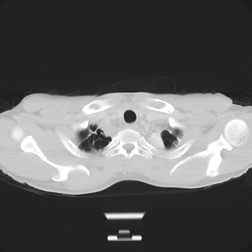 Cerebellar metastasis - adenocarcinoma lung (Radiopaedia 63184-71717 Axial lung window 9).png