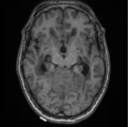 Cerebellar metastasis from lung adenocarcinoma (Radiopaedia 86690-102829 Axial T1 36).png