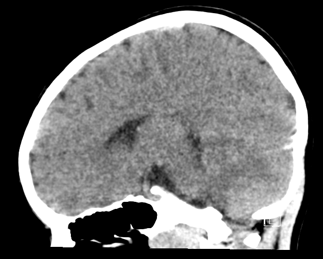 File:Cerebellar stroke (Radiopaedia 32202-33149 B 14).png