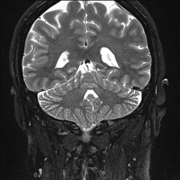 File:Cerebellopontine angle meningioma (Radiopaedia 53561-59591 Coronal T2 21).jpg
