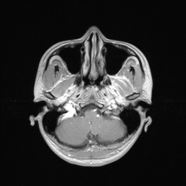 Cerebral abscess (Radiopaedia 24212-24478 Axial T1 C+ 14).jpg