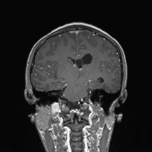 Cerebral abscess (Radiopaedia 24212-24478 Coronal T1 C+ 120).jpg