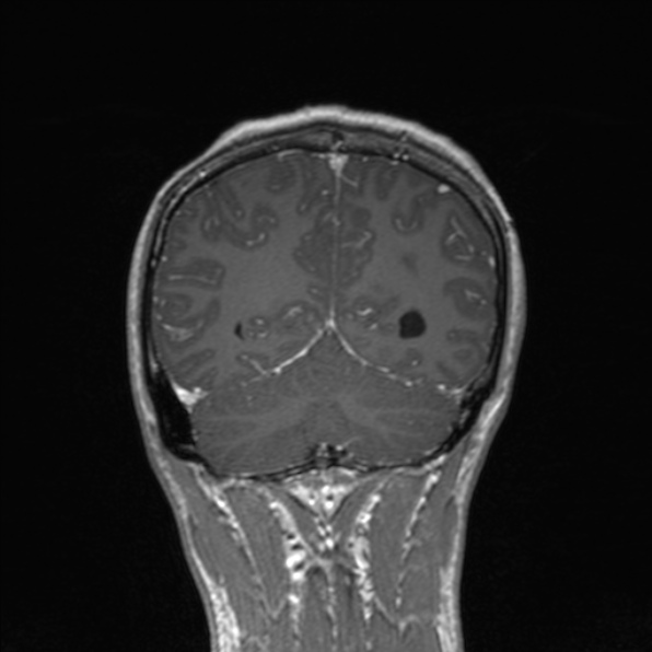 Cerebral abscess (Radiopaedia 24212-24478 Coronal T1 C+ 156).jpg