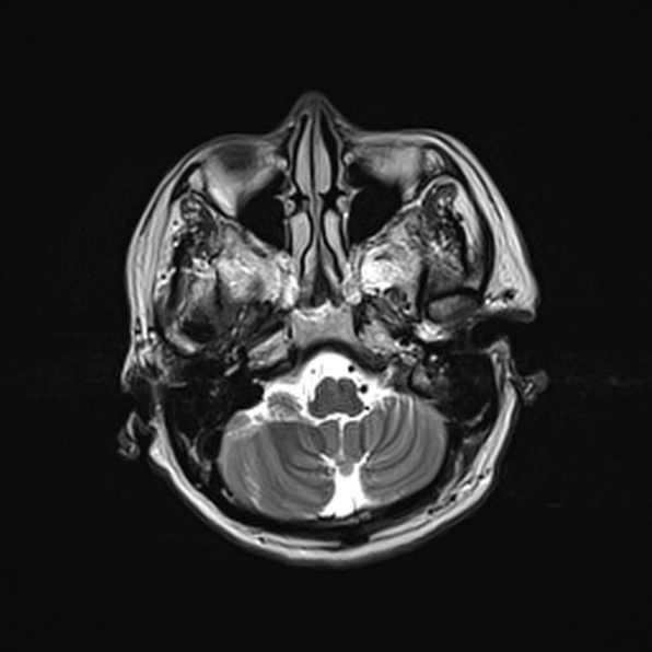 Cerebral abscess (Radiopaedia 26111-26247 Axial T2 16).jpg