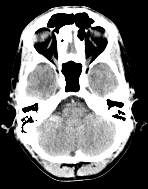 Cerebral abscess (Radiopaedia 60342-68008 Axial C+ delayed 12).png