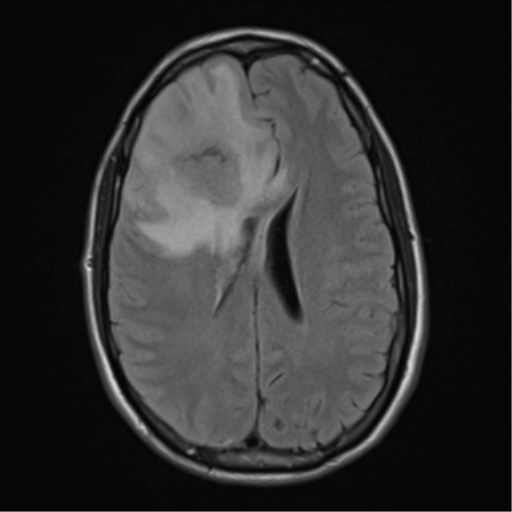 File:Cerebral abscess (Radiopaedia 60342-68009 Axial FLAIR 19).png