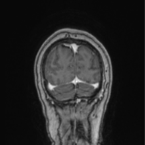 Cerebral abscess from pulmonary arteriovenous malformation (Radiopaedia 86275-102291 L 14).png