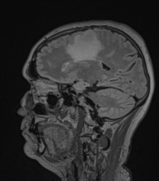 Cerebral abscess from pulmonary arteriovenous malformation (Radiopaedia 86275-102291 Sagittal FLAIR 45).png