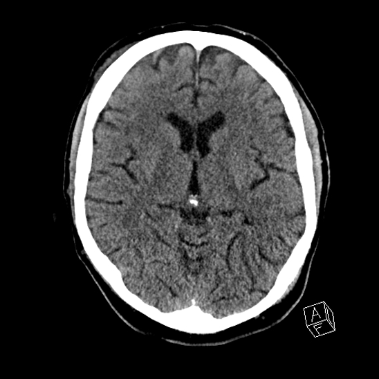 Cerebral abscess with ventriculitis (Radiopaedia 78965-91876 Axial non-contrast 25).jpg