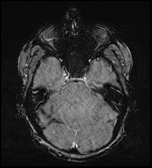 Cerebral abscess with ventriculitis (Radiopaedia 78965-91878 Axial SWI 19).jpg