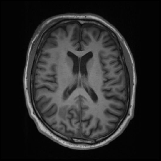 File:Cerebral abscess with ventriculitis (Radiopaedia 78965-91878 Axial T1 29).jpg