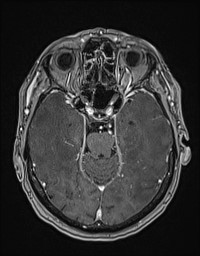 Cerebral amyloid angiopathy-related inflammation (Radiopaedia 58270-65377 Axial T1 C+ fat sat 49).jpg