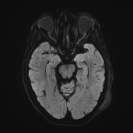 Cerebral amyloid angiopathy-related inflammation (Radiopaedia 74836-85849 Axial DWI 42).jpg