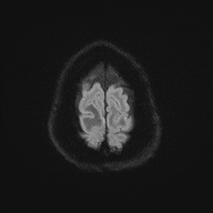 Cerebral amyloid angiopathy-related inflammation (Radiopaedia 74836-85849 Axial DWI 57).jpg