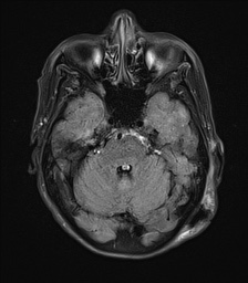 File:Cerebral amyloid angiopathy-related inflammation (Radiopaedia 74836-85849 Axial FLAIR 9).jpg