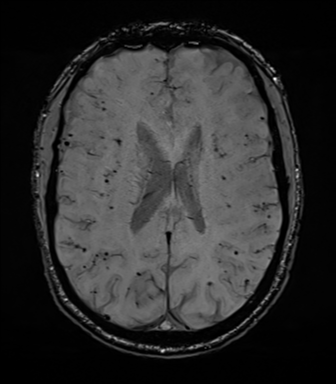 Cerebral amyloid angiopathy (Radiopaedia 46082-50433 Axial SWI 51).png