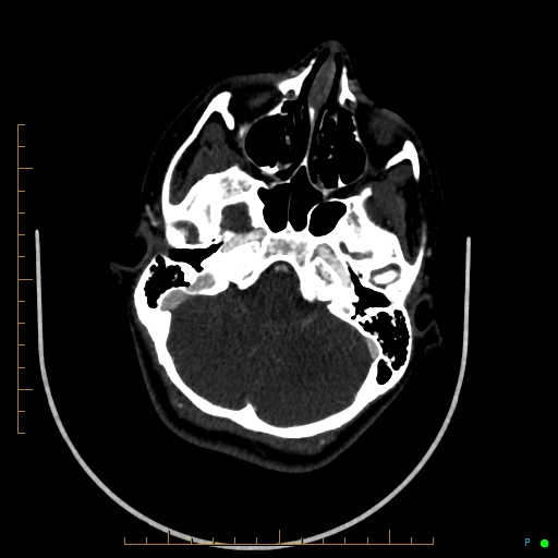 Cerebral arteriovenous malformation (AVM) (Radiopaedia 78162-90706 Axial CTA 74).jpg