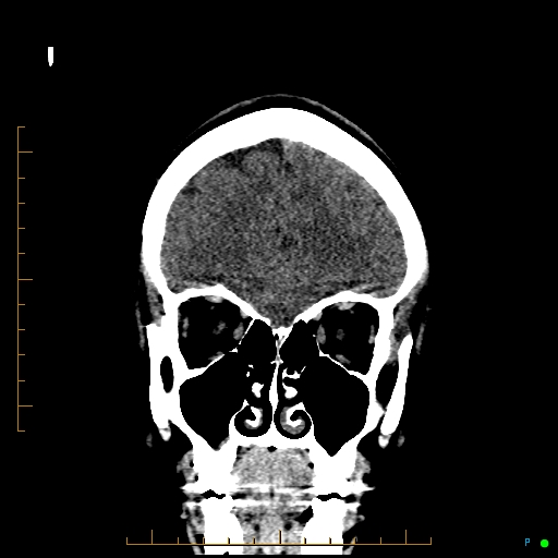 File:Cerebral arteriovenous malformation (AVM) (Radiopaedia 78162-90706 Coronal non-contrast 23).jpg