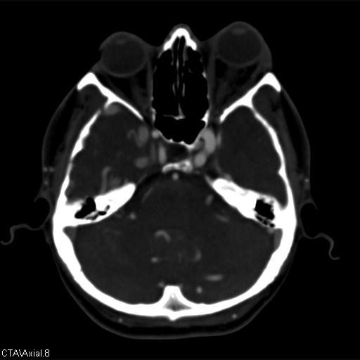 Cerebral arteriovenous malformation (Radiopaedia 28518-28759 B 8).jpg