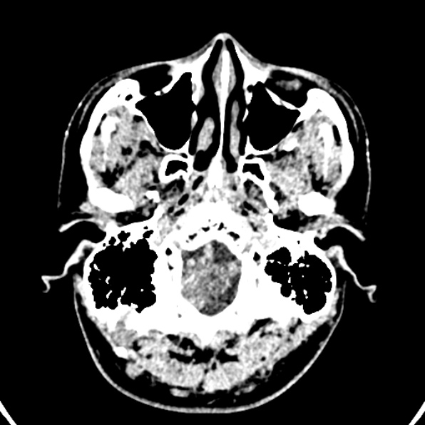 Cerebral arteriovenous malformation (Radiopaedia 37182-39012 Axial non-contrast 4).jpg