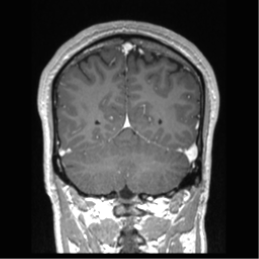 Cerebral arteriovenous malformation (Radiopaedia 39259-41506 Coronal T1 C+ 27).png
