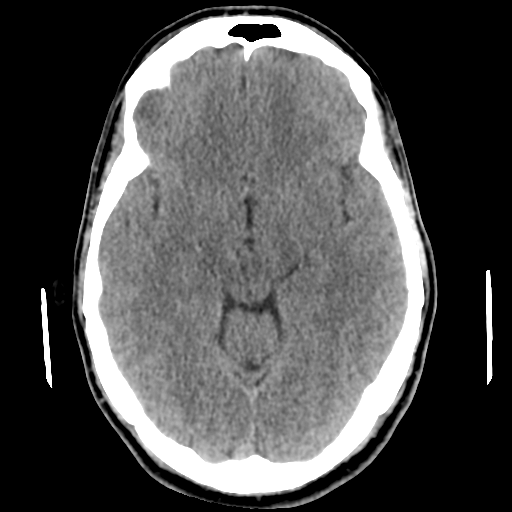 File:Cerebral arteriovenous malformation (Radiopaedia 55798-62371 Axial non-contrast 24).png