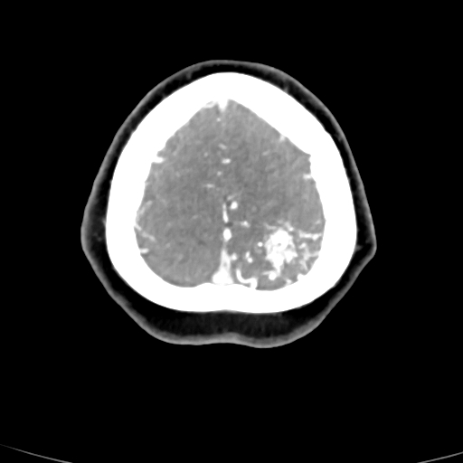 Cerebral arteriovenous malformation (Radiopaedia 73830-84645 B 12).jpg