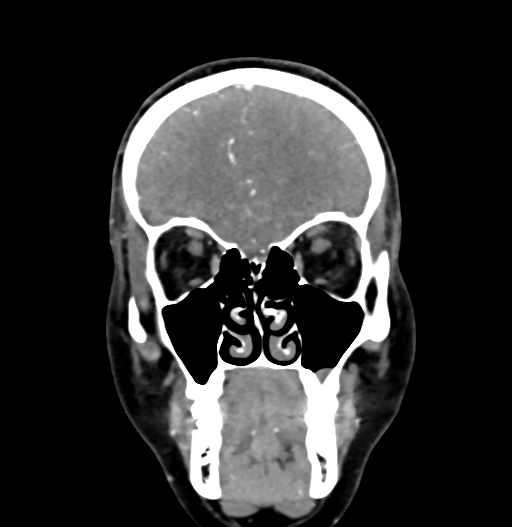 Cerebral arteriovenous malformation (Radiopaedia 73830-84645 C 22).jpg