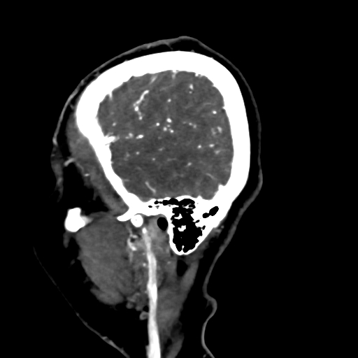 Cerebral arteriovenous malformation (Radiopaedia 73830-84645 Sagittal C+ delayed 80).jpg