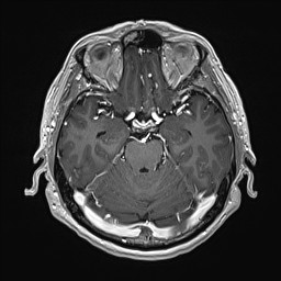 Cerebral arteriovenous malformation (Radiopaedia 84015-99245 Axial T1 C+ 60).jpg