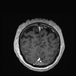 Cerebral arteriovenous malformation (Radiopaedia 84015-99245 Coronal T1 C+ 146).jpg