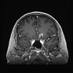 Cerebral arteriovenous malformation (Radiopaedia 84015-99245 Coronal T1 C+ 56).jpg
