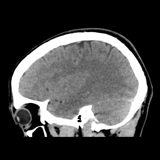 Cerebral arteriovenous malformation (Spetzler-Martin grade 2) (Radiopaedia 41262-44076 A 21).png