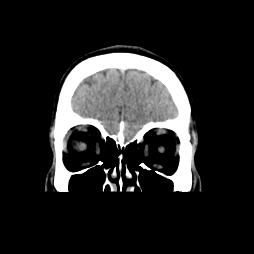 Cerebral arteriovenous malformation (Spetzler-Martin grade 2) (Radiopaedia 41262-44076 Coronal non-contrast 10).png
