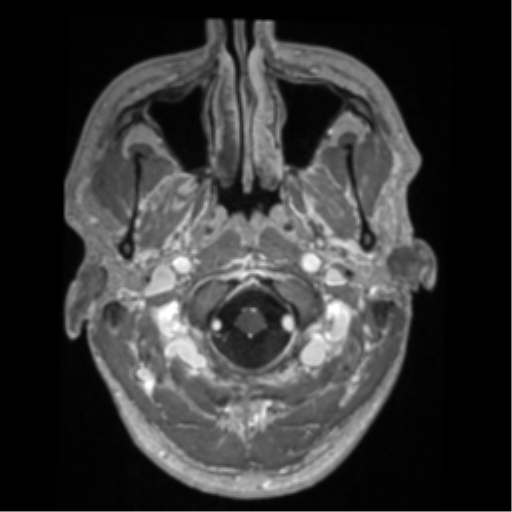 Cerebral arteriovenous malformation - huge (Radiopaedia 35734-37272 Axial T1 C+ 2).png