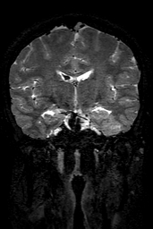 Cerebral arteriovenous malformation at posterior body of corpus callosum (Radiopaedia 74111-84925 Coronal T2 86).jpg