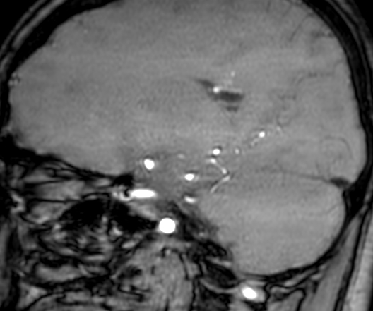 Cerebral arteriovenous malformation at posterior body of corpus callosum (Radiopaedia 74111-84925 J 145).jpg