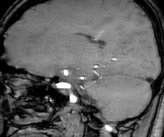 Cerebral arteriovenous malformation at posterior body of corpus callosum (Radiopaedia 74111-84925 J 149).jpg