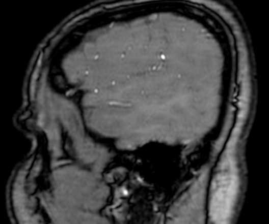Cerebral arteriovenous malformation at posterior body of corpus callosum (Radiopaedia 74111-84925 J 27).jpg