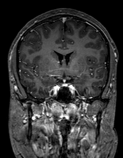 Cerebral arteriovenous malformation at posterior body of corpus callosum (Radiopaedia 74111-84925 K 155).jpg