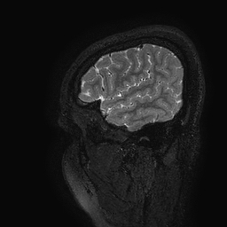 Cerebral arteriovenous malformation at posterior body of corpus callosum (Radiopaedia 74111-84925 Sagittal T2 124).jpg