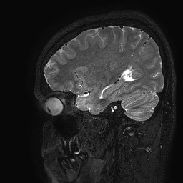 Cerebral arteriovenous malformation at posterior body of corpus callosum (Radiopaedia 74111-84925 Sagittal T2 98).jpg