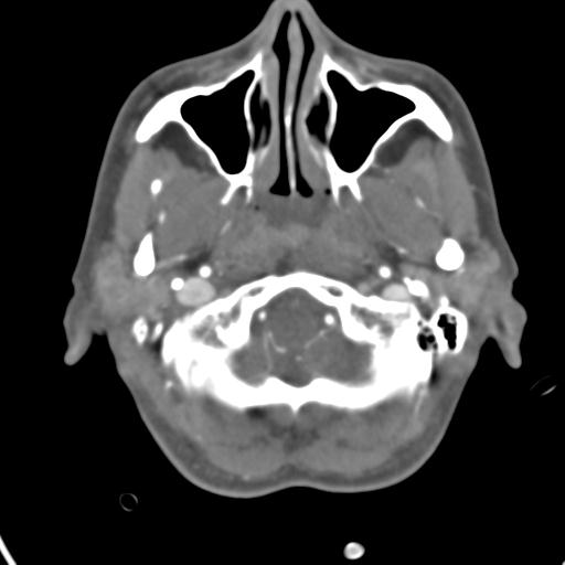Cerebral arteriovenous malformation with hemorrhage (Radiopaedia 28773-29073 A 48).jpg