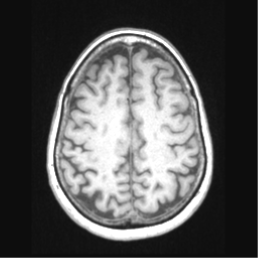 Cerebral arteriovenous malformation with hemorrhage (Radiopaedia 34422-35737 Axial T1 57).png